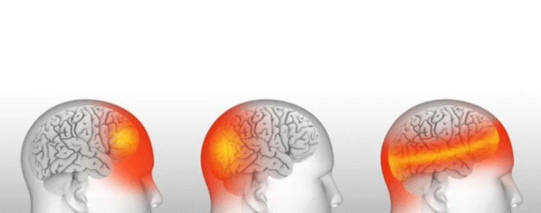 Understanding the location types of headaches